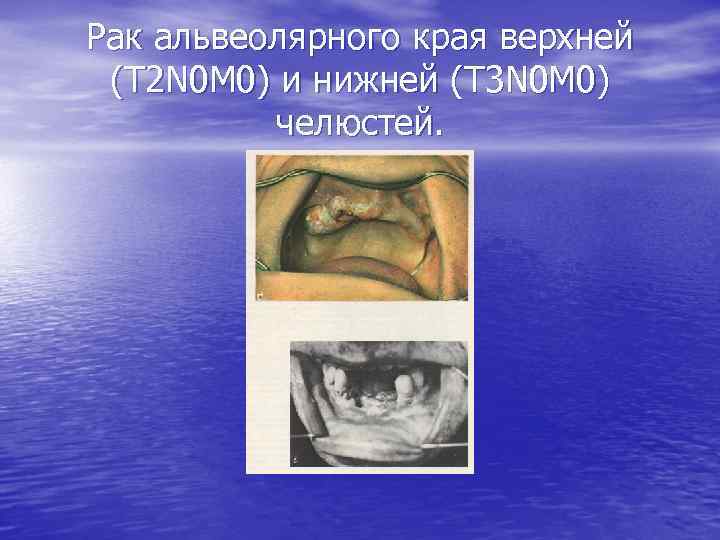 Рак альвеолярного края верхней (Т 2 N 0 M 0) и нижней (Т 3
