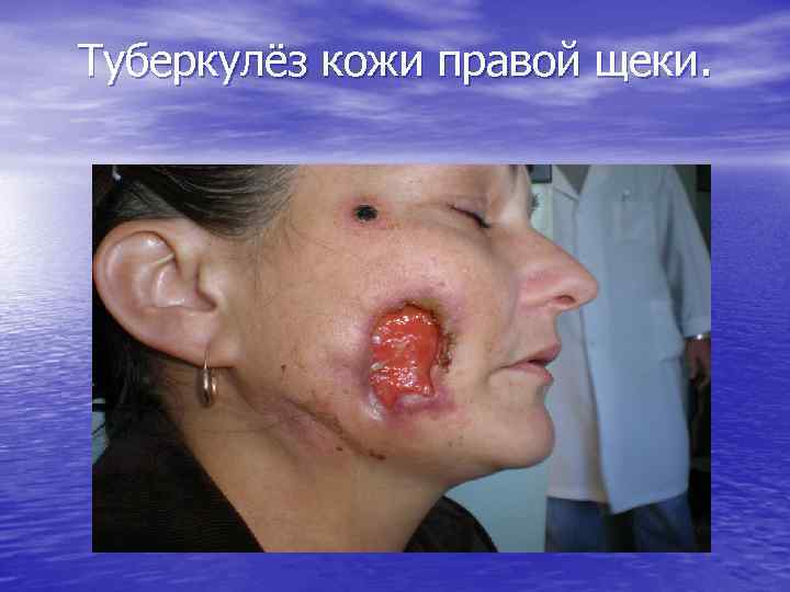 Туберкулёз кожи правой щеки. 