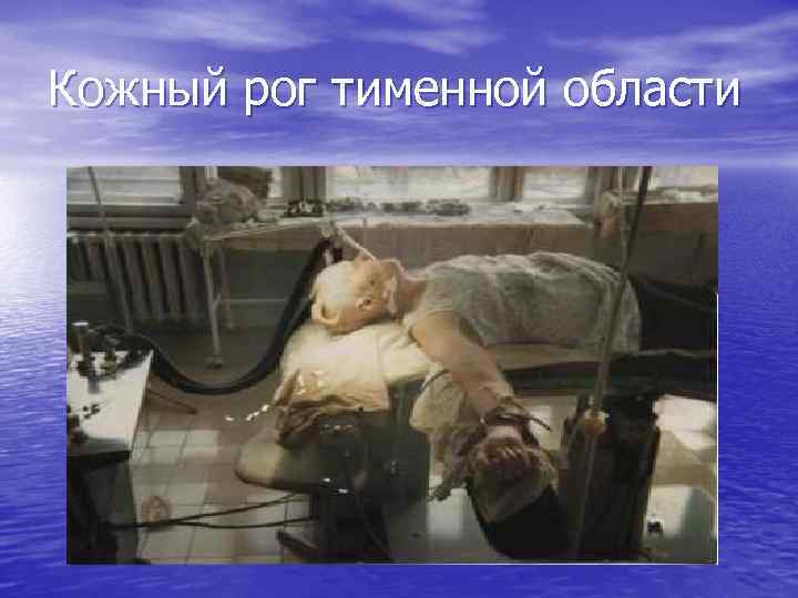 Кожный рог тименной области 