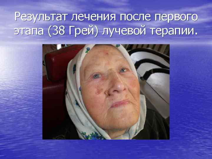 Результат лечения после первого этапа (38 Грей) лучевой терапии. 