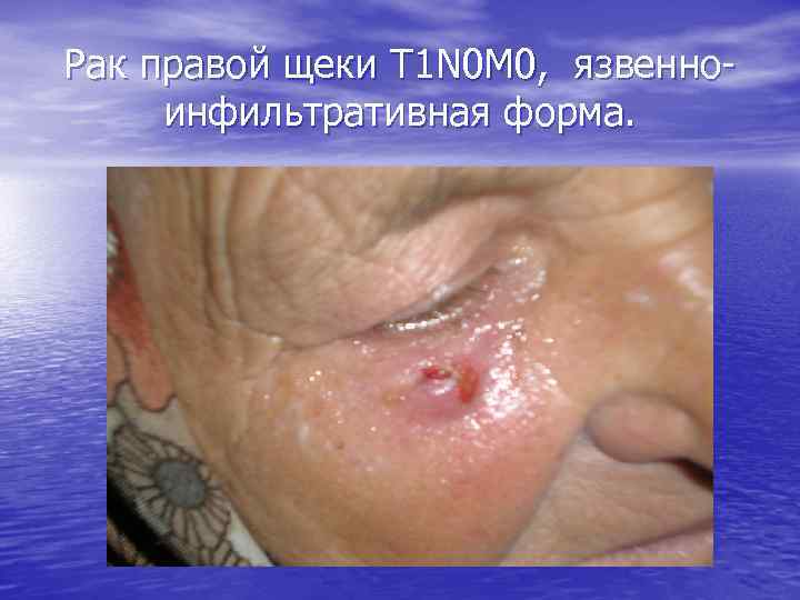 Рак правой щеки Т 1 N 0 M 0, язвенноинфильтративная форма. 