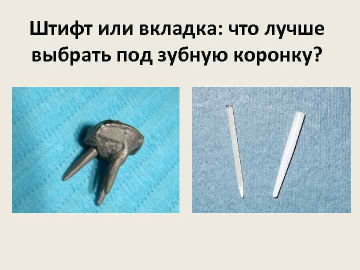 Штифт или вкладка: что лучше выбрать под зубную коронку? 