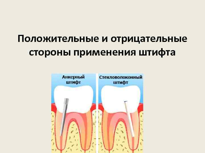 Положительные и отрицательные стороны применения штифта 
