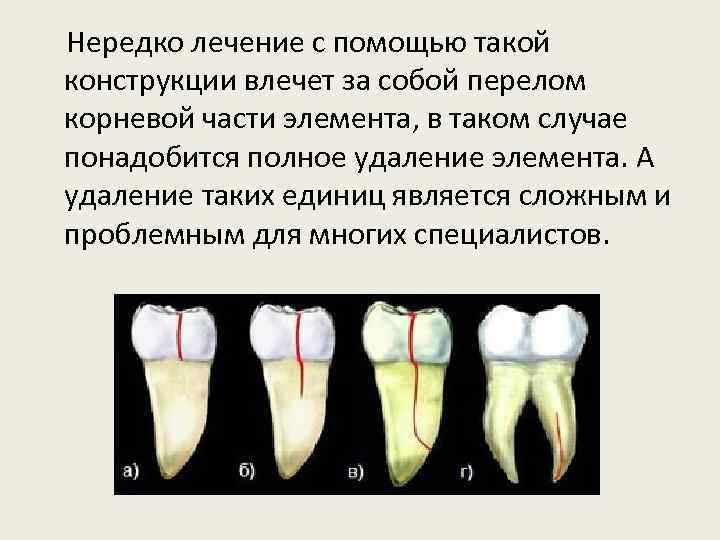  Нередко лечение с помощью такой конструкции влечет за собой перелом корневой части элемента,