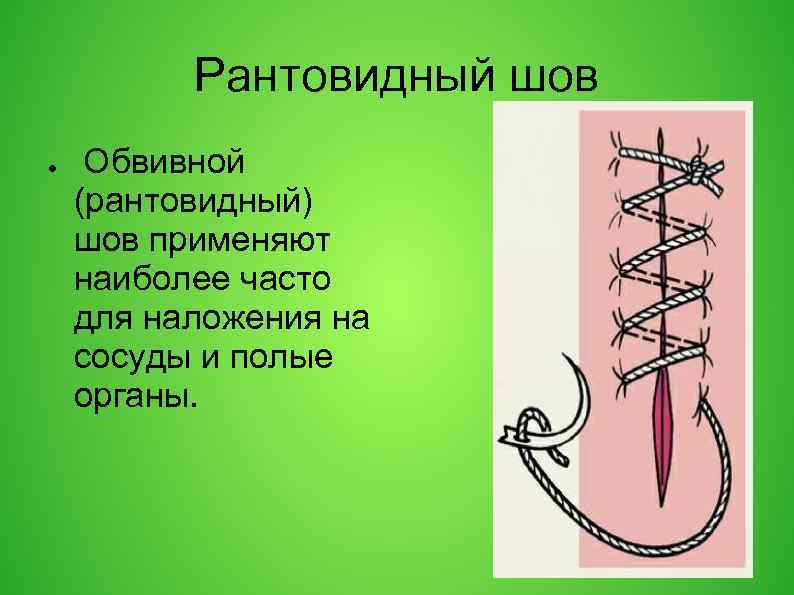 Шов мультановского схема