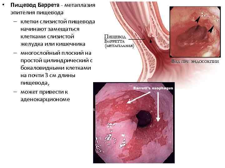 • Пищевод Баррета - метаплазия эпителия пищевода – клетки слизистой пищевода начинают замещаться