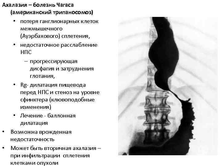 Ахалазия – болезнь Чагаса (американский трипаносомоз) • потеря ганглионарных клеток межмышечного (Ауэрбахового) сплетения, •