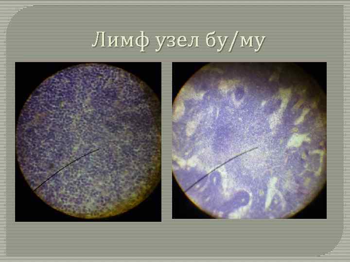 Лимф узел бу/му 