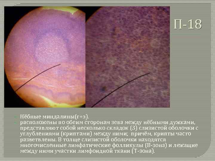 П-18 Нёбные миндалины(г+э). расположены по обеим сторонам зева между нёбными дужками, представляют собой несколько