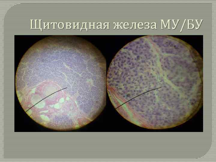 Щитовидная железа МУ/БУ 