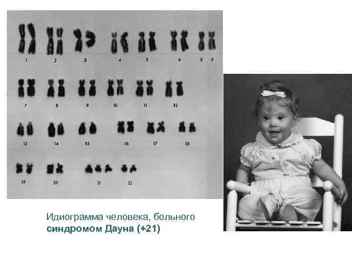 Идиограмма человека, больного синдромом Дауна (+21) 