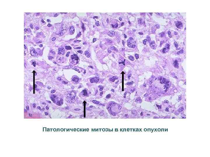 Патологические митозы в клетках опухоли 
