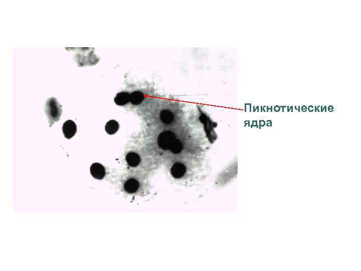 Пикнотические ядра 
