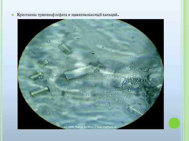  Кристаллы трипельфосфата и щавелевокислый кальций. 