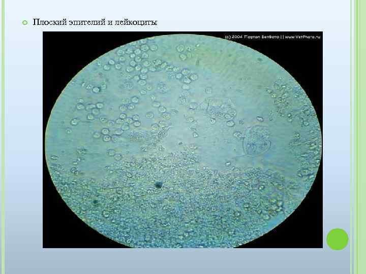  Плоский эпителий и лейкоциты 