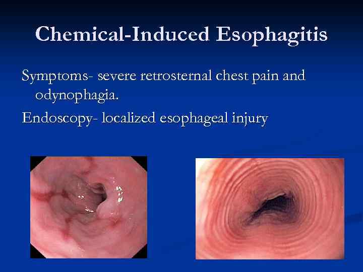 Chemical-Induced Esophagitis Symptoms- severe retrosternal chest pain and odynophagia. Endoscopy- localized esophageal injury 