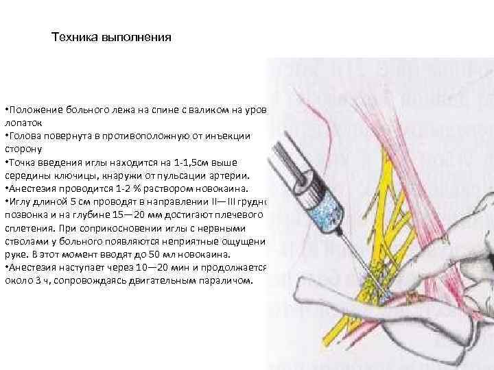 Повреждение нервных стволов при инъекции фото