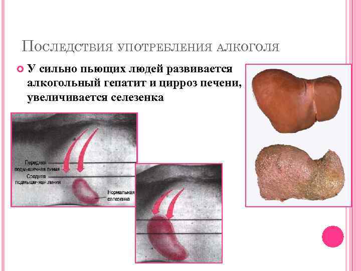 ПОСЛЕДСТВИЯ УПОТРЕБЛЕНИЯ АЛКОГОЛЯ У сильно пьющих людей развивается алкогольный гепатит и цирроз печени, увеличивается