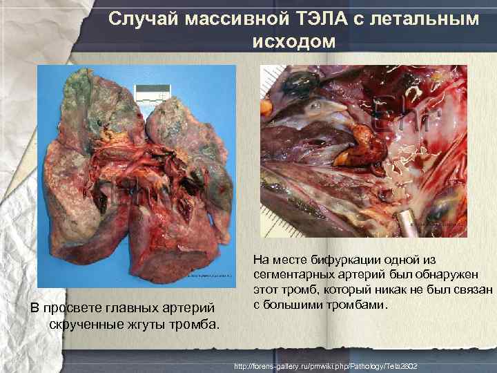 Случай массивной ТЭЛА с летальным исходом В просвете главных артерий скрученные жгуты тромба. На