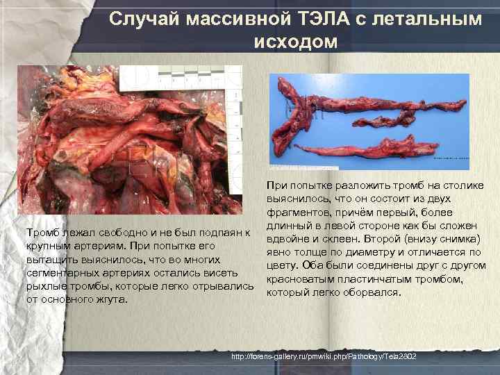 Случай массивной ТЭЛА с летальным исходом Тромб лежал свободно и не был подпаян к