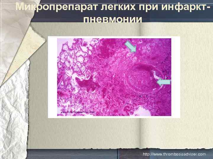 Микропрепарат легких при инфарктпневмонии http: //www. thrombosisadviser. com 