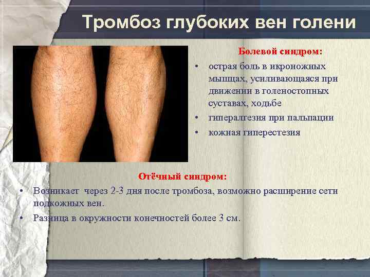 Тромбоз глубоких вен голени Болевой синдром: • острая боль в икроножных мышцах, усиливающаяся при