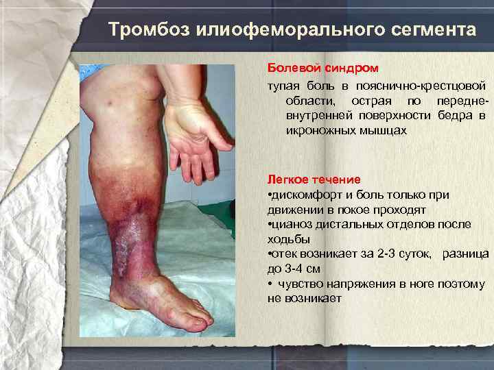 Тромбоз илиофеморального сегмента Болевой синдром тупая боль в пояснично-крестцовой области, острая по передневнутренней поверхности