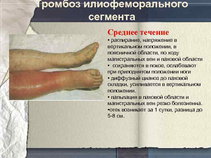 Тромбоз илиофеморального сегмента Среднее течение • распирание, напряжение в вертикальном положении, в поясничной области,