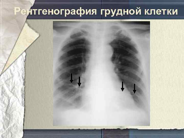 Рентгенография грудной клетки 