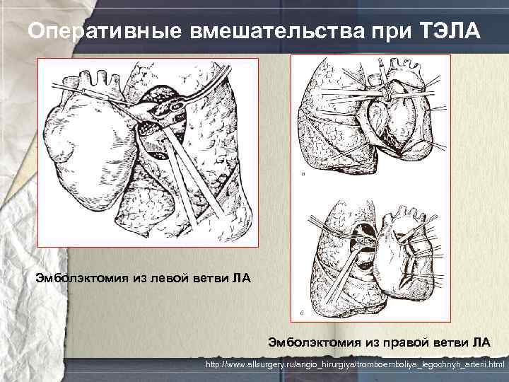 Оперативные вмешательства при ТЭЛА Эмболэктомия из левой ветви ЛА Эмболэктомия из правой ветви ЛА