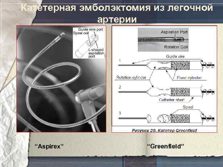 Катетерная эмболэктомия из легочной артерии “Aspirex” “Greenfield” 