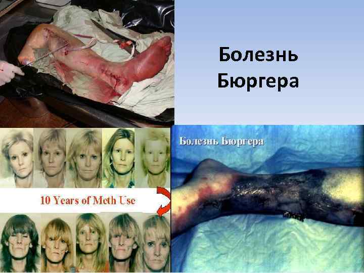 Болезнь Бюргера 