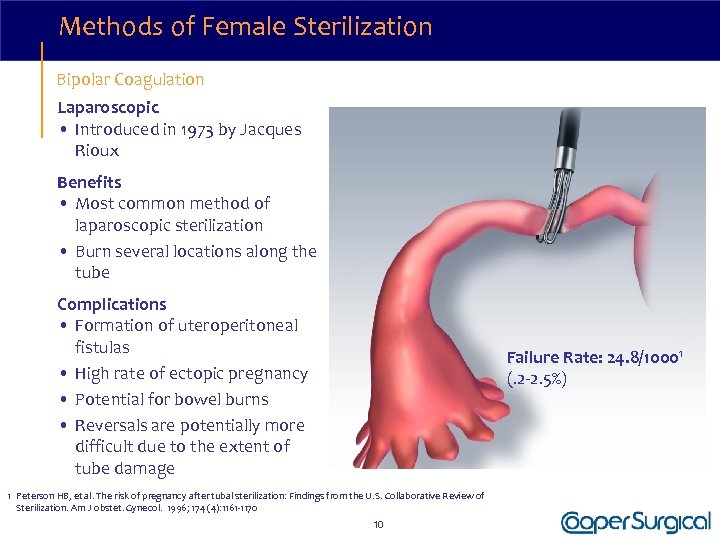 Methods of Female Sterilization Bipolar Coagulation Laparoscopic • Introduced in 1973 by Jacques Rioux