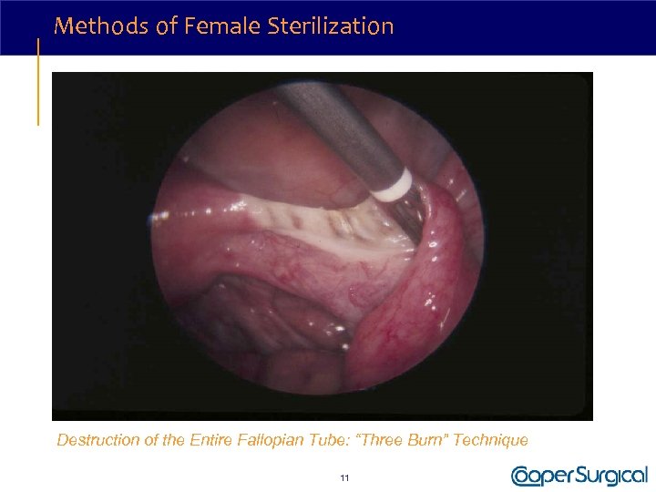Methods of Female Sterilization Destruction of the Entire Fallopian Tube: “Three Burn” Technique 11