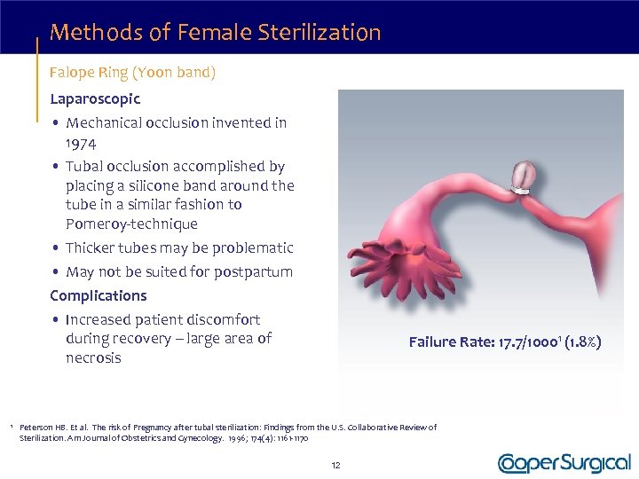 Methods of Female Sterilization Falope Ring (Yoon band) Laparoscopic • Mechanical occlusion invented in