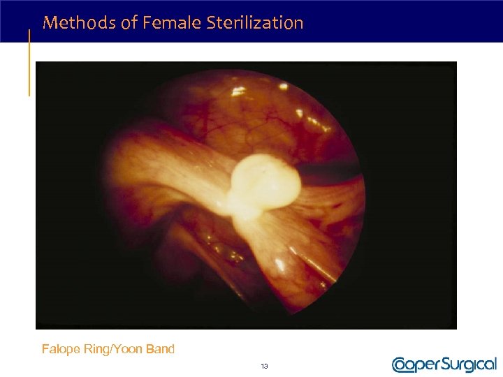 Methods of Female Sterilization Falope Ring/Yoon Band 13 