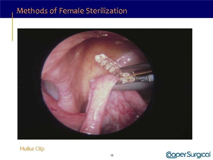 Methods of Female Sterilization Hulka Clip 15 