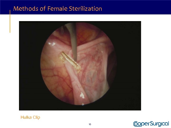 Methods of Female Sterilization Hulka Clip 16 