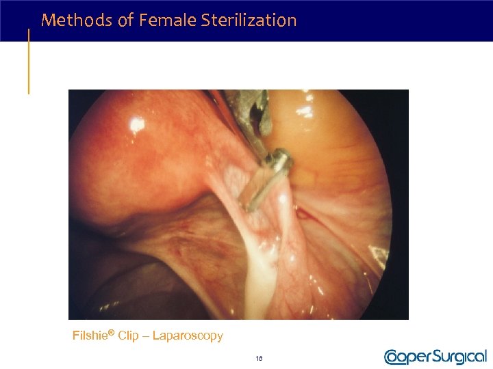 Methods of Female Sterilization Filshie® Clip – Laparoscopy 18 