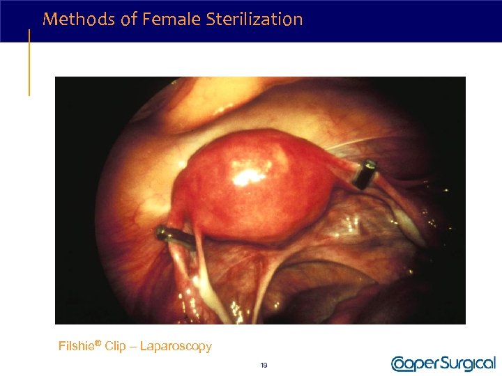 Methods of Female Sterilization Filshie® Clip – Laparoscopy 19 