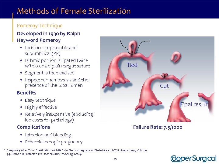 Methods of Female Sterilization Pomeroy Technique Developed in 1930 by Ralph Hayword Pomeroy •
