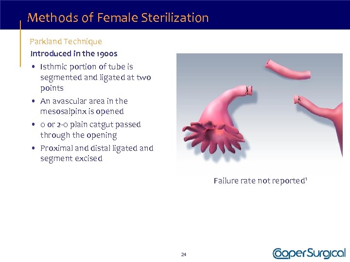 Methods of Female Sterilization Parkland Technique Introduced in the 1900 s • Isthmic portion