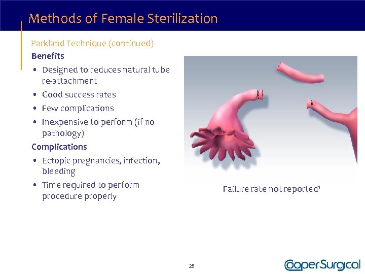 Methods of Female Sterilization Parkland Technique (continued) Benefits • Designed to reduces natural tube