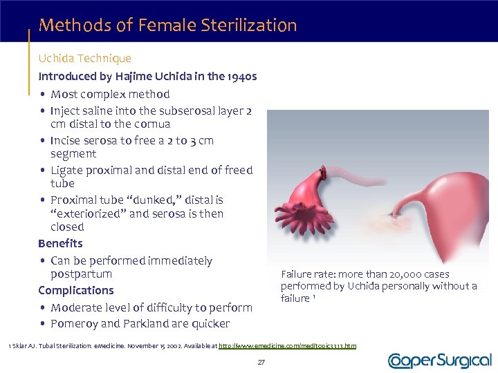 Methods of Female Sterilization Uchida Technique Introduced by Hajime Uchida in the 1940 s