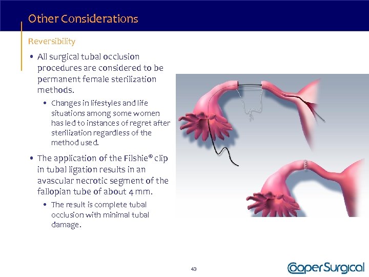 Other Considerations Reversibility • All surgical tubal occlusion procedures are considered to be permanent