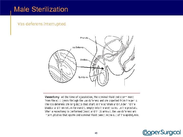 Male Sterilization Vas deferens interrupted 46 