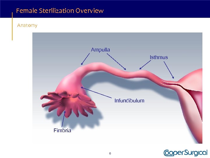 Female Sterilization Overview Anatomy Ampulla Isthmus Infundibulum Fimbria 6 