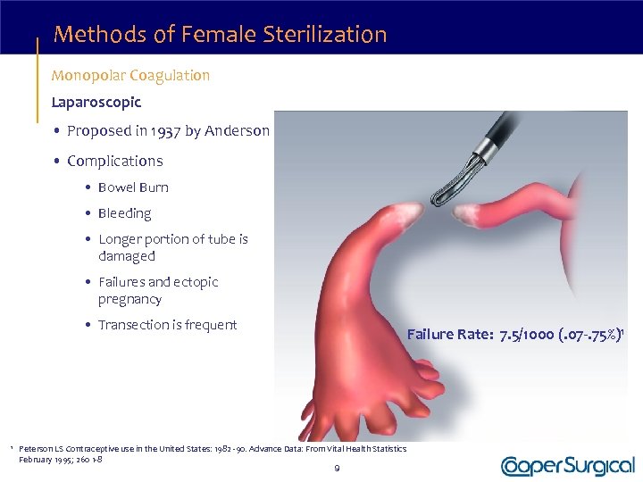 Methods of Female Sterilization Monopolar Coagulation Laparoscopic • Proposed in 1937 by Anderson •