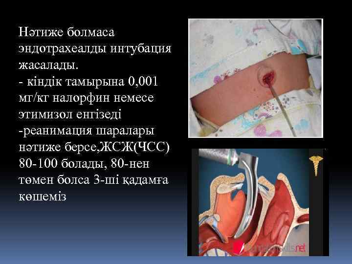 Нәтиже болмаса эндотрахеалды интубация жасалады. - кіндік тамырына 0, 001 мг/кг налорфин немесе этимизол