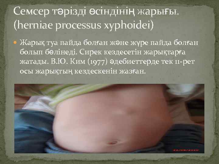 Семсер тәрізді өсіндінің жарығы. (herniae processus xyphoidei) Жарық туа пайда болған және жүре пайда